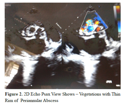 2D Echo Psax View Showing