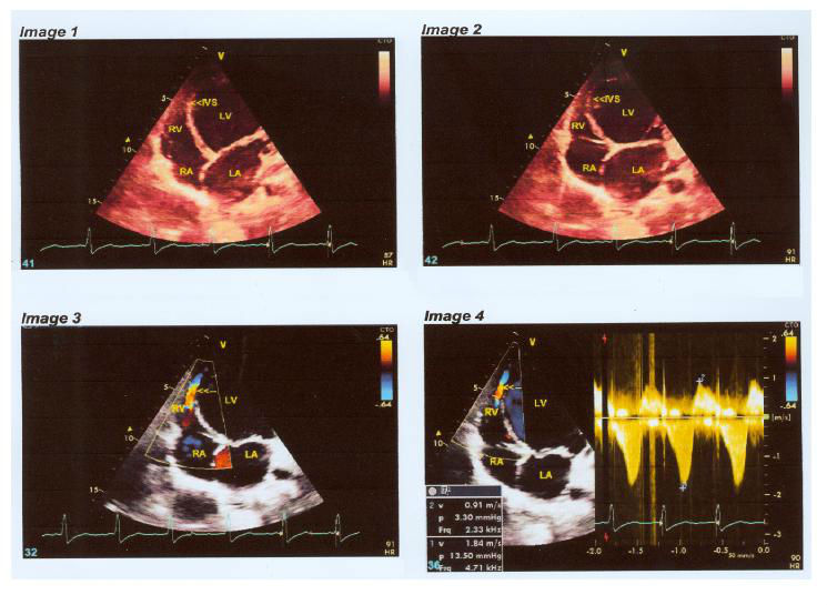 Right Ventricular Mid-cavity Dynamic Systolic Obstruction