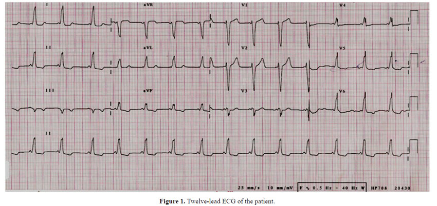 Wpw Syndrome Delta Wave